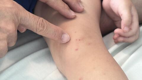 Tay chân miệng tăng mạnh, phụ huynh còn tâm lý chủ quan