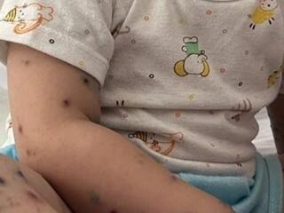 Vaccine phòng tay chân miệng được cấp phép tại Việt Nam