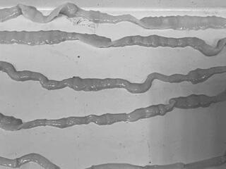 Khánh Hòa ghi nhận hơn 1.400 ca nhiễm giun sán