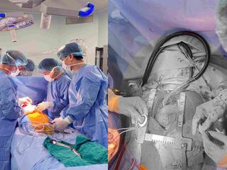 Người bệnh suy tim giai đoạn cuối có thêm cơ hội sống nhờ CorHeart 6