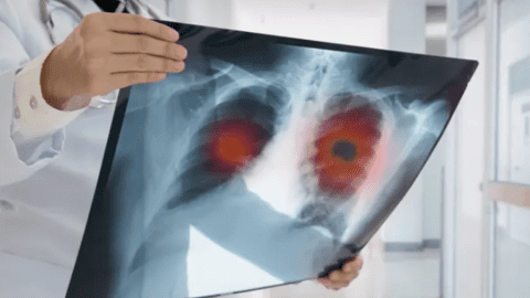 Nghiên cứu ra thuốc chữa ung thư phổi giảm nguy cơ tử vong 51%