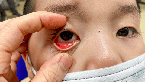 Đau mắt đỏ ở trẻ em có thể gây nhiều biến chứng