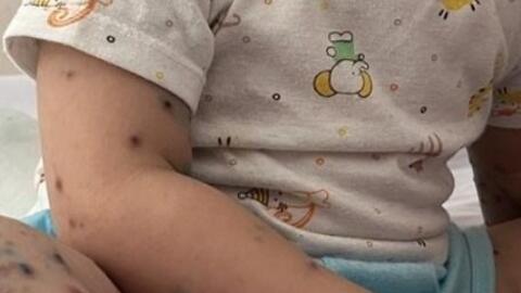 Vaccine phòng tay chân miệng được cấp phép tại Việt Nam