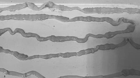 Khánh Hòa ghi nhận hơn 1.400 ca nhiễm giun sán