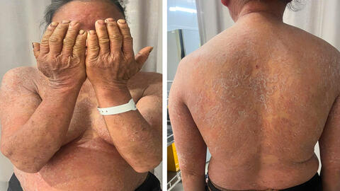 Tự ý dùng thuốc bôi, nấm da từ nhẹ lan khắp cơ thể