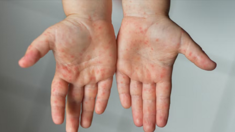 Tay chân miệng gia tăng: Cảnh giác dấu hiệu không điển hình