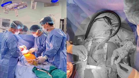 Người bệnh suy tim giai đoạn cuối có thêm cơ hội sống nhờ CorHeart 6