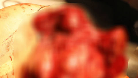 Căn bệnh gặm nhấm 10.000 ca mới mỗi năm ở Việt Nam