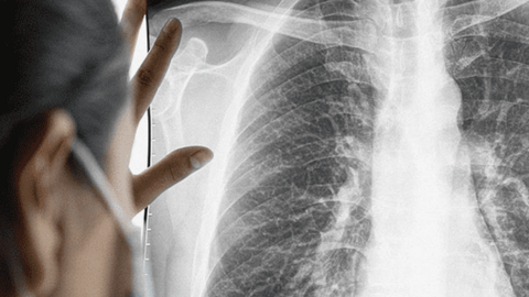 2 yếu tố tăng nguy cơ mắc ung thư phổi đang 'bủa vây' người Việt: Phòng tránh thế nào?