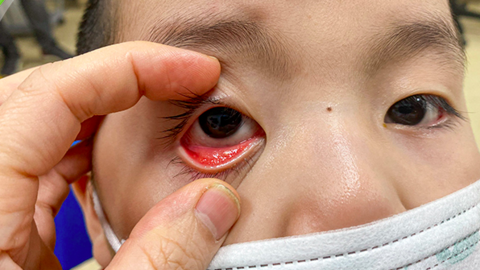 Đau mắt đỏ ở trẻ em có thể gây nhiều biến chứng
