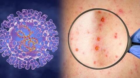 Bộ Y tế tăng cường giám sát, điều trị, không để lây nhiễm chéo bệnh đậu mùa khỉ