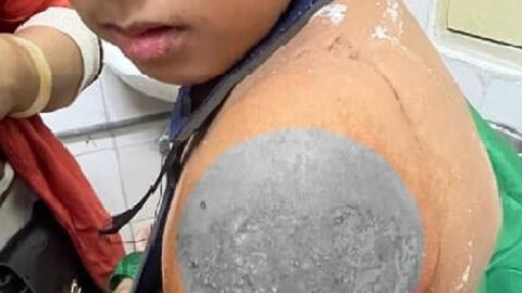 Nguy cơ nhiễm trùng, hoại tử do gẫy xương bó lá