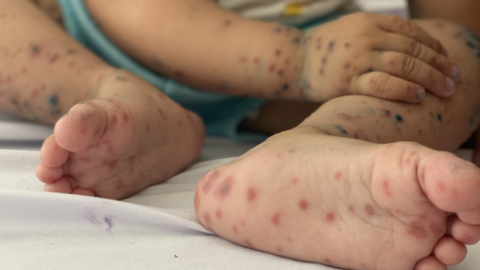 Hà Nội ghi nhận 41 ca mắc sốt xuất huyết