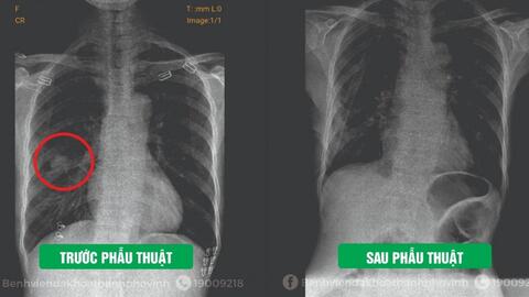 Phẫu thuật thành công cắt thùy phổi nội soi cho bệnh nhân ung thư