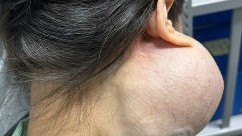 Phẫu thuật cho nữ bệnh nhân có khối u khủng trên mặt