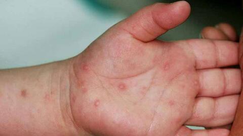 Dịch tay chân miệng tăng rất mạnh, ghi nhận ca trẻ em tử vong ở Đồng Thâp