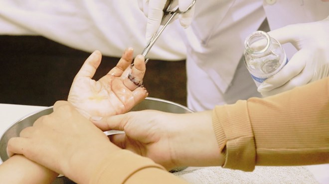 Bệnh nhi 6 tuổi đứt lìa các ngón tay khi bổ quả mít