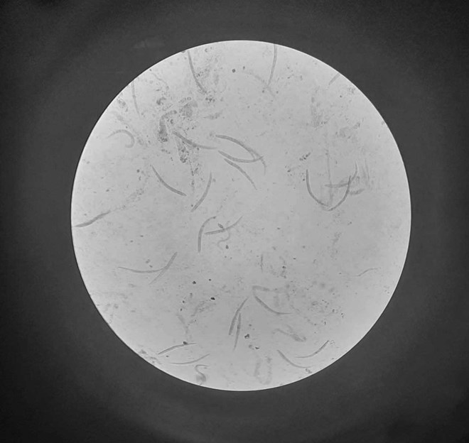 Người đàn ông nguy kịch vì nhiễm giun lươn lan toả