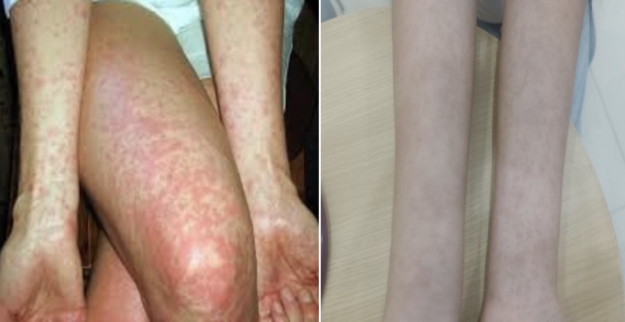 Các nốt phát ban của bệnh nhân mắc sởi. Ảnh: BVCC