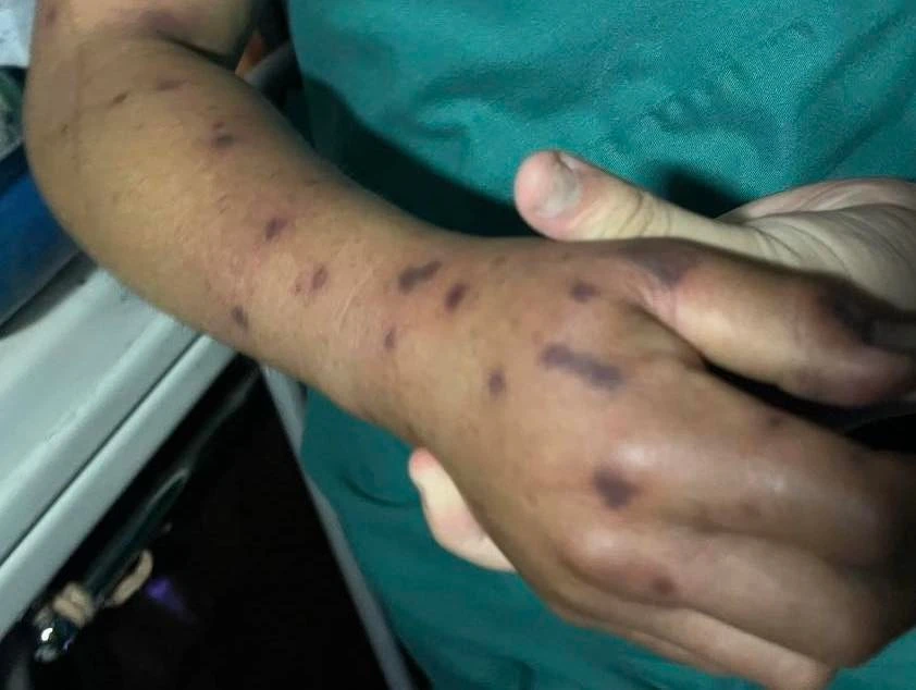 Bệnh nhân bị sốc phản vệ độ 3 do ong đốt.