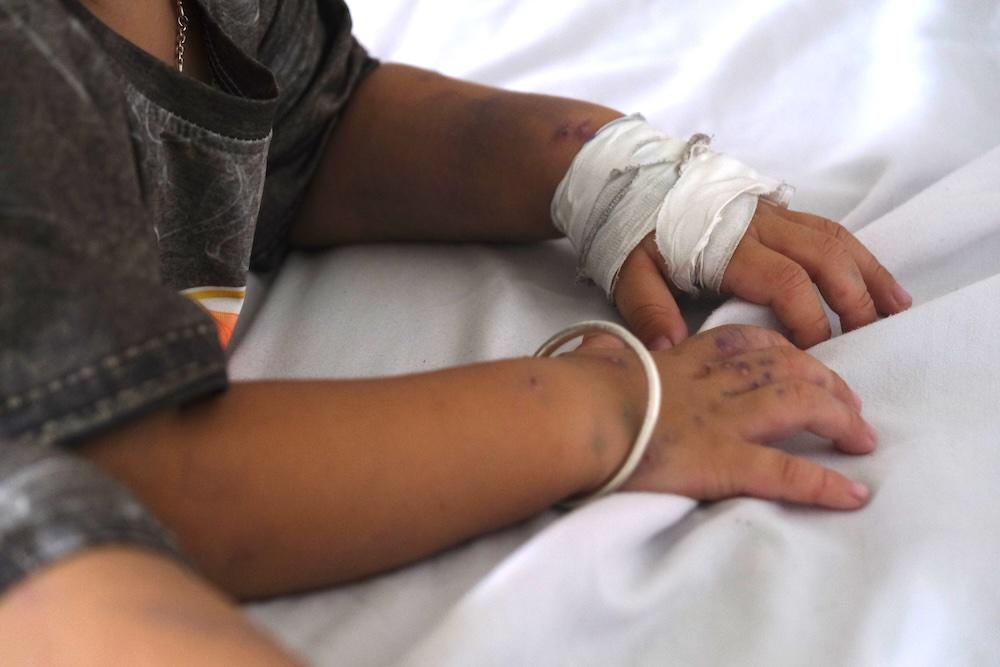 Tại Năm nay, các mụn nước nổi rõ rệt trên da bệnh nhi bị tay chân miệng