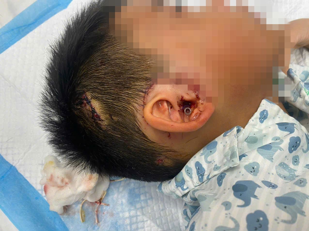 Một bệnh nhi phải nhập viện cấp cứu vì tai nạn thương tích. Ảnh: BVCC