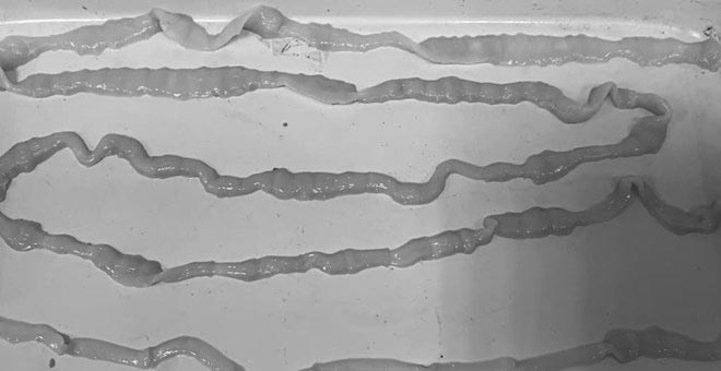 Khánh Hòa ghi nhận hơn 1.400 ca nhiễm giun sán