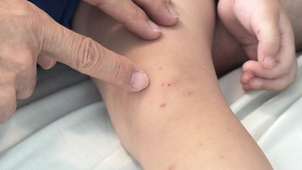 Trẻ xuất hiện đốm đỏ nghi tay chân miệng được bác sĩ thăm khám, theo dõi điều trị. Ảnh: Hoàng Lộc