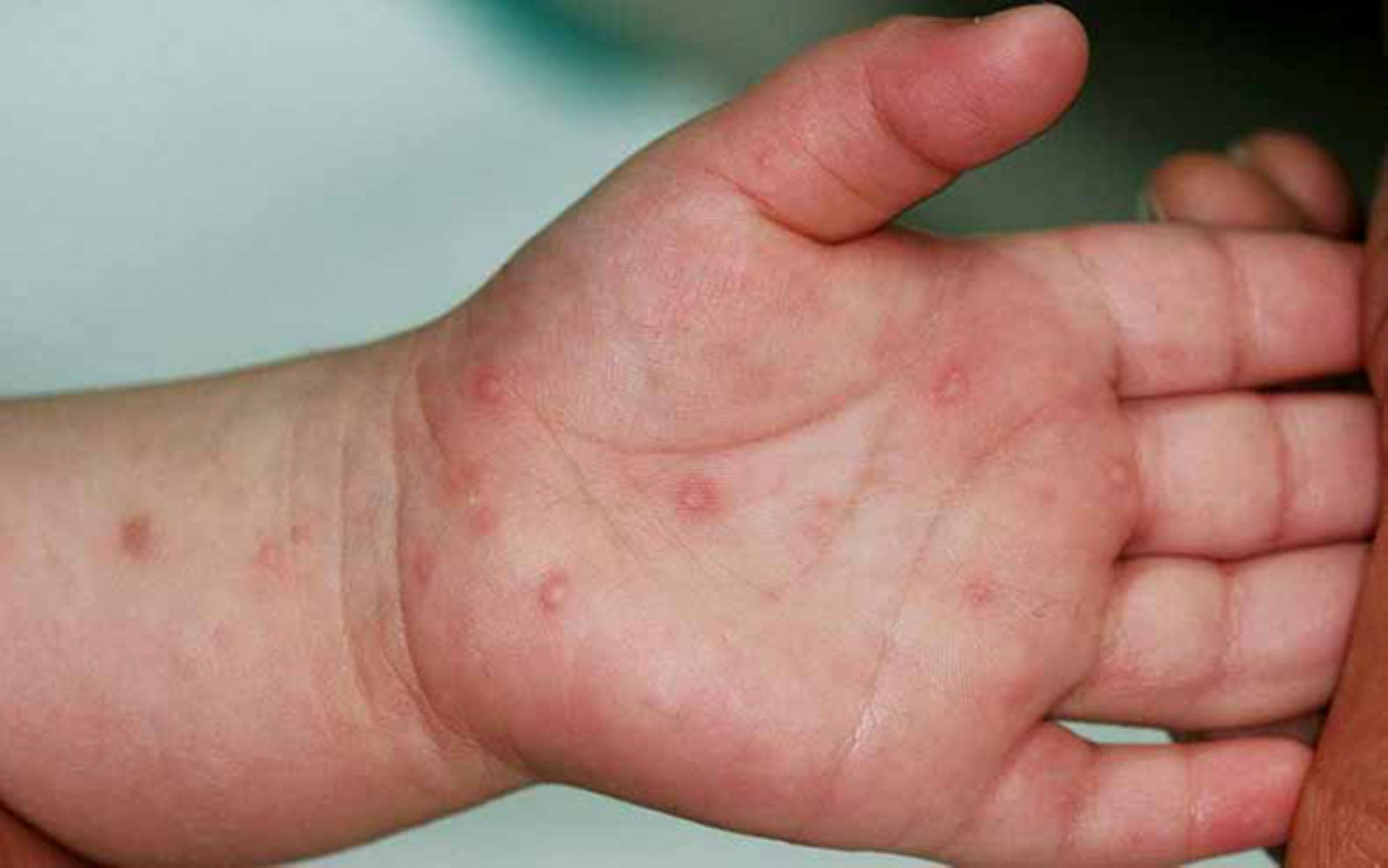 Biểu hiện trên bệnh nhân bị nhiễm dịch tay chân miệng. Ảnh: Cổng thông tin điện tử tỉnh Đồng Tháp