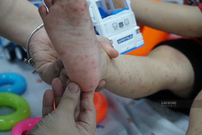 Ca bệnh tay chân miệng ở TPHCM tăng, vượt ngưỡng trung bình 5 năm